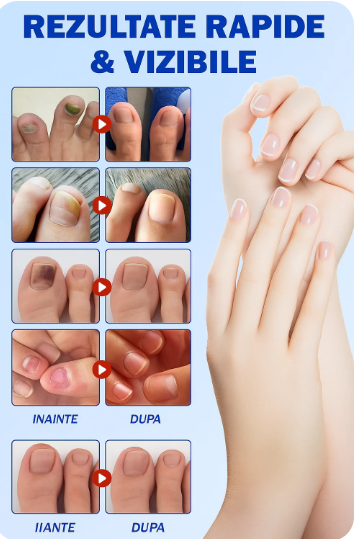 Plasturi Reparare Unghii – Extra Putere Antifungică